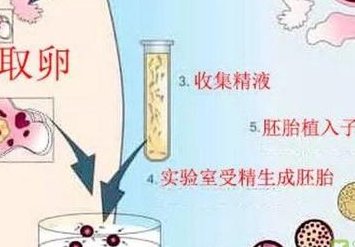 试管怀孕10周后在医生的指导下减药会导致胎停吗？