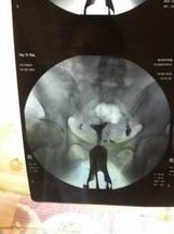 广州三代试管婴儿哪里最便宜（广州三代试管婴儿较好的医院）